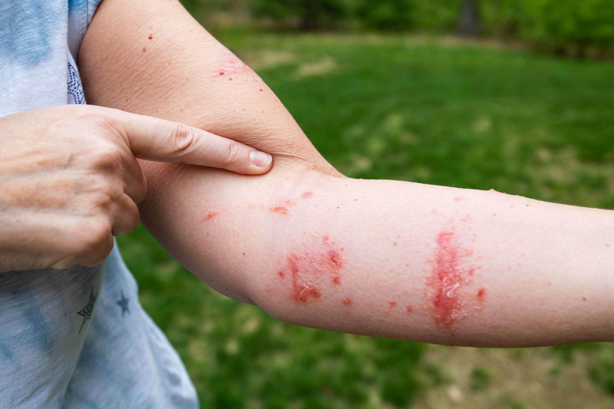 Poison Ivy Rash, Poison Oak, Poison Sumac: Symptoms, Causes